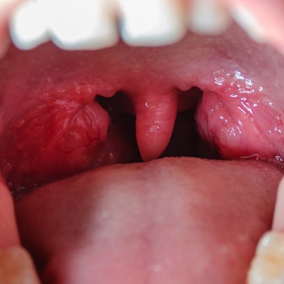 Intracapsular Tonsillectomy with Coblator 