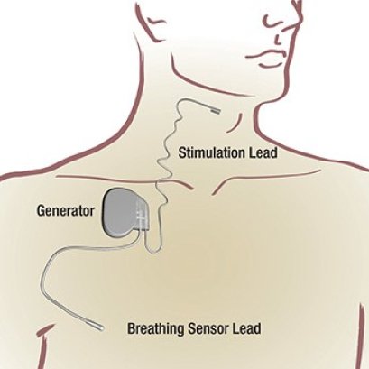 เครื่องกระตุ้นทางเดินหายใจ..ความหวังใหม่..รักษานอนกรน