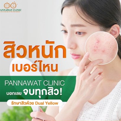 รักษาสิวด้วย Dual Yellow
