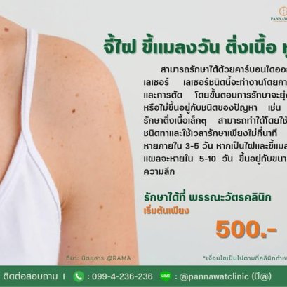 จี้ไฝ ขี้แมลงวัน ติ่งเนื้อ​ ​หูด