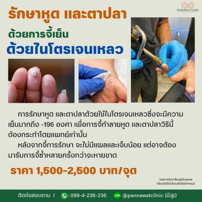 ไนโตรเจน​เหลว​การรักษา​หูด​ 