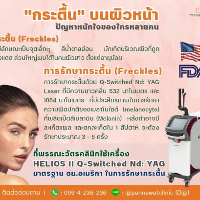 ✅ การรักษา​กระ​ตื้น​ (Freckles) ด้วย Q-Switched Nd: YAG Laser 