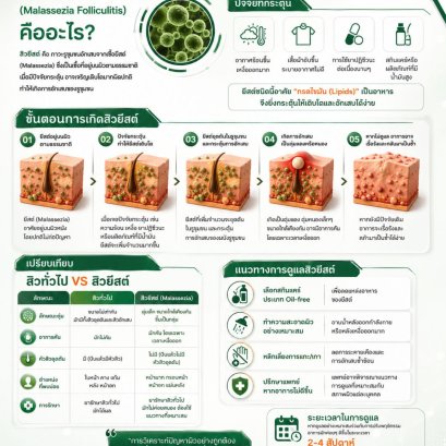  สิวยีสต์ คืออะไร? ทำไมทายาสิวแล้วไม่ค่อยดีขึ้น?
