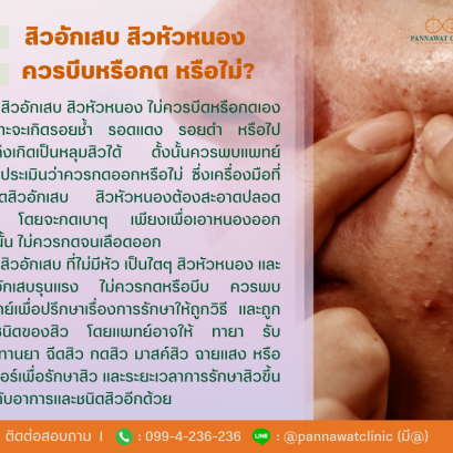 สิวอักเสบ สิวหัวหนอง ควรบีบหรือกดหรือไม่?