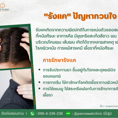 "รังแค ปัญหากวนใจ"