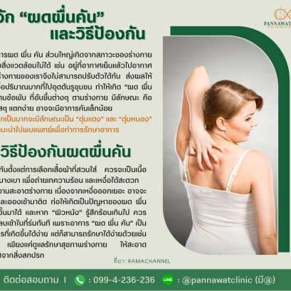 รู้จัก “ผดผื่นคัน” และวิธีป้องกัน