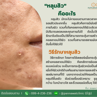 “หลุมสิว”  คืออะไร