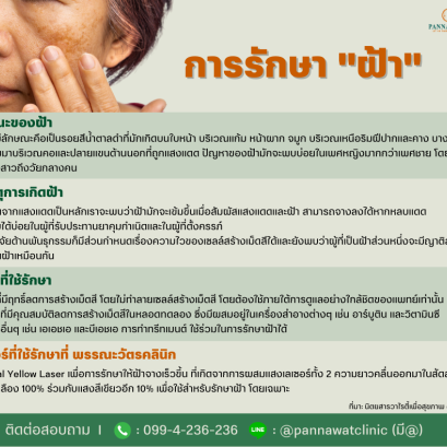การรักษา "ฝ้า"