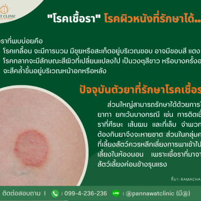 "โรคเชื้อรา" โรคผิวหนังที่รักษาได้...