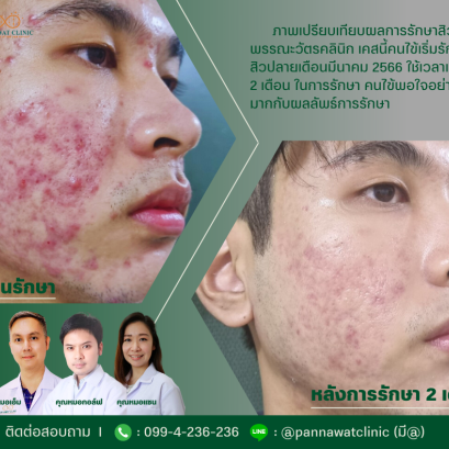 รักษาสิวที่พรรณะวัตรคลินิก
