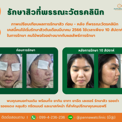 รักษาสิวที่พรรณะวัตรคลินิก