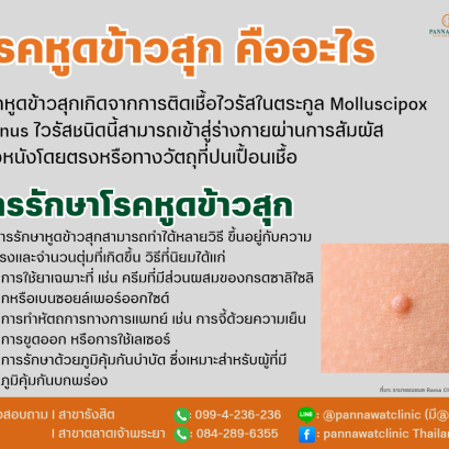 หูดข้าวสุก​คืออะไร