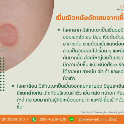 ผื่นผิวหนังอักเสบจากเชื้อรา