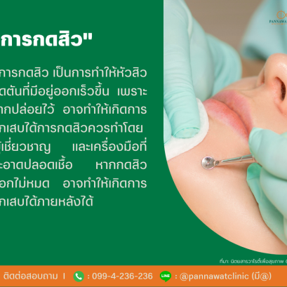 การกดสิว 