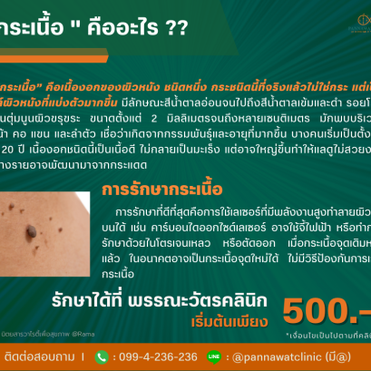 การรักษากระเนื้อ