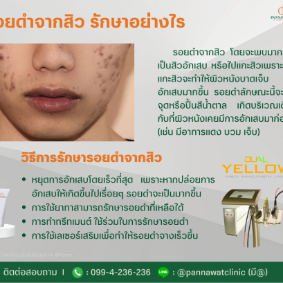 การรักษารอยดำรอยแดงจากสิว