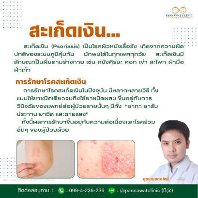 สะเก็ดเงิน (Psoriasis)