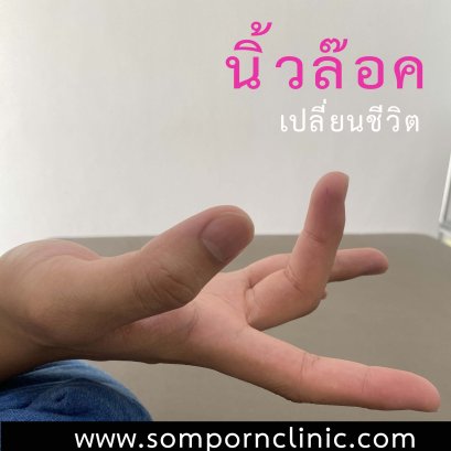 นิ้วล๊อค เปลี่ยนชีวิต