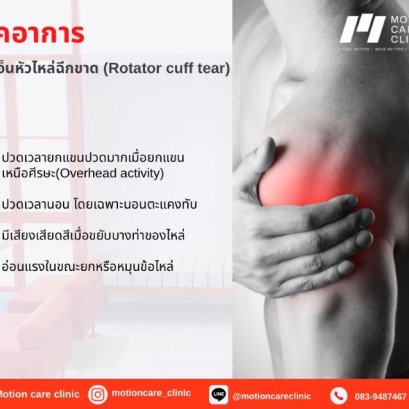 เช็คลิสอาการ เอ็นหัวไหล่ฉีกขาด (Rotator cuff tear)