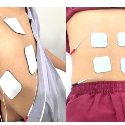 TRANSCUTANEOUS ELECTRICAL NERVE STIMULATION (TENS) 