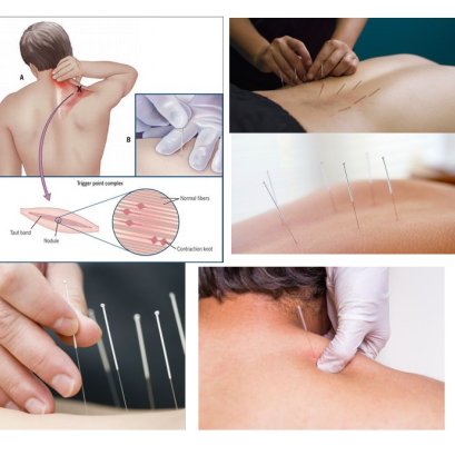 ฝังเข็ม หรือแทงเข็มเข้าจุดปวด ( DRY NEEDLING / TRIGGER POINT RELEASE)