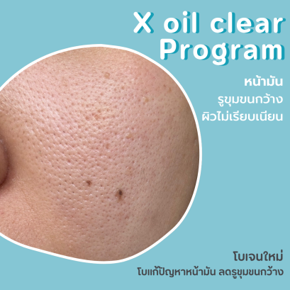 X oil clear program โบแก้ปัญหาหน้ามัน ลดรูขุมขนกว้างง่ายๆ