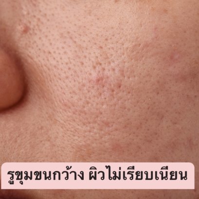 รูขุมขนกว้าง