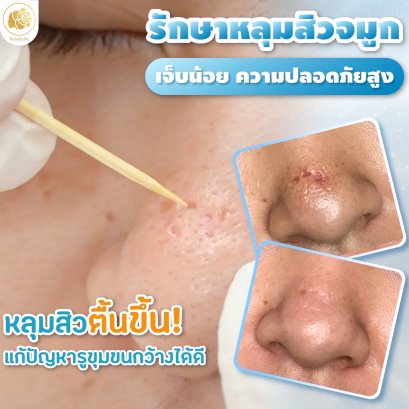 รักษาหลุมสิวจมูก ด้วย TCA CROSS หลุมสิวลึกหายได้จริง ที่โรสเบลล์คลินิก