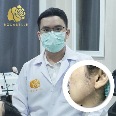 ลิฟท์กรอบหน้าเรียวสวย