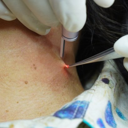 เลเซอร์ตัดติ่งเนื้อ