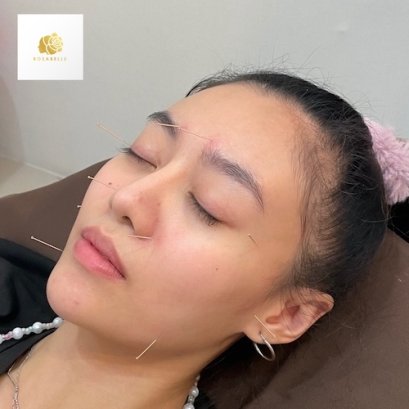 รักษาสิว ฝังเข็ม ช่วยให้หน้าใส ลดสิว ที่โรสเบลล์คลินิก