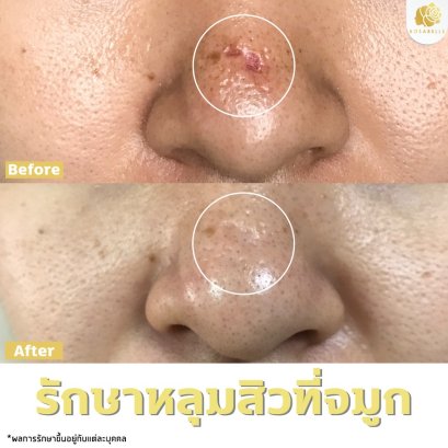 รักษาหลุมสิวที่จมูก