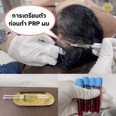 การเตรียมตัวก่อนทำ PRP ผม ลดผมหลุดร่วง กระตุ้นการงอกผมใหม่