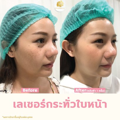 รักษากระด้วยเลเซอร์ กระหายได้จริงไหม ดูรีวิวที่นี่