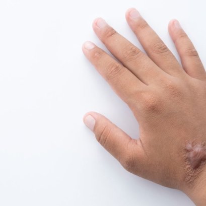 Scarless 4D Laser ไม่ได้ช่วยแค่หลุมสิว แต่ยังช่วยแผลเป็นนูน