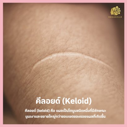 คีลอยด์ (Keloid) คืออะไร และรักษาได้อย่างไรดี