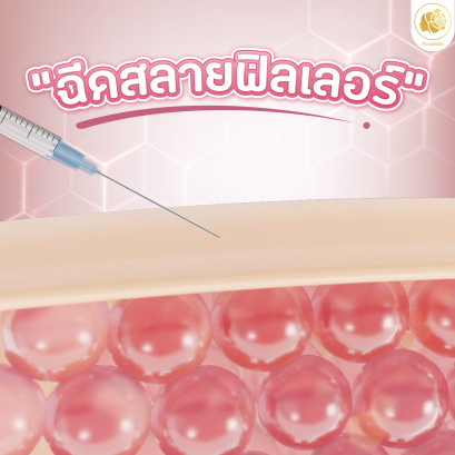 ฉีดสลายฟิลเลอร์ สลายได้หมดไหม และควรทำกี่ครั้ง