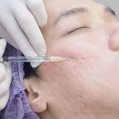 Subcision เทคนิคการรักษาหลุมสิว เห็นผลดีเยี่ยม