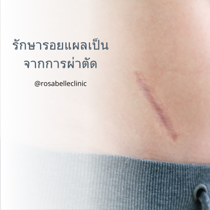 รักษารอยแผลเป็นผ่าตัดด้วยเลเซอร์