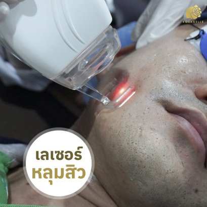 เลเซอร์หลุมสิว PDRNหลุมสิว เลาะพังผืดหลุมสิว TCA