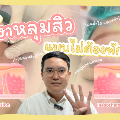 วิธีรักษาหลุมสิวแบบไม่ต้องพักหน้า ที่โรสเบลล์คลินิก