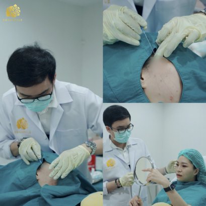 ร้อยไหม ยกกระชับใบหน้าโดยไม่ต้องผ่าตัด