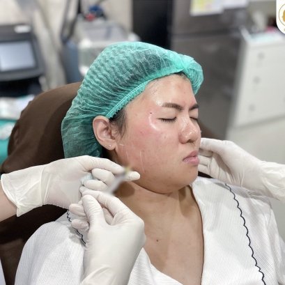 ลดปัญหานอนกัดฟันด้วยโบท็อกซ์ ที่โรสเบลล์คลินิก