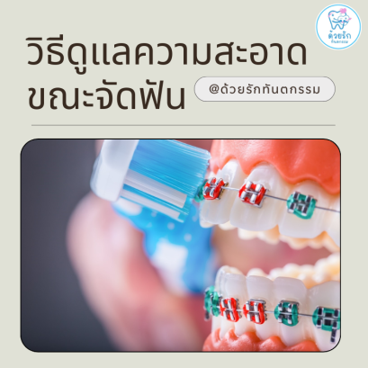 วิธีดูแลความสะอาดขณะจัดฟัน