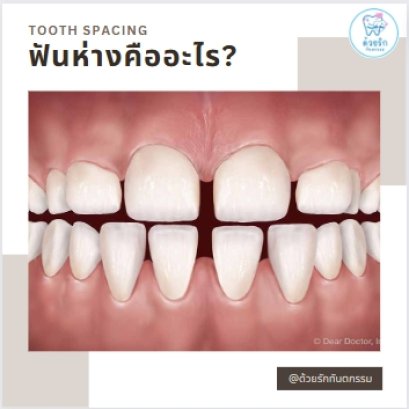 สาเหตุที่ทำให้ฟันห่าง?