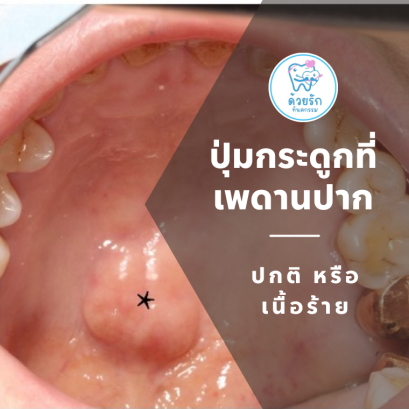 ปุ่มกระดูกที่เพดานปาก ปกติ หรือ เนื้อร้าย