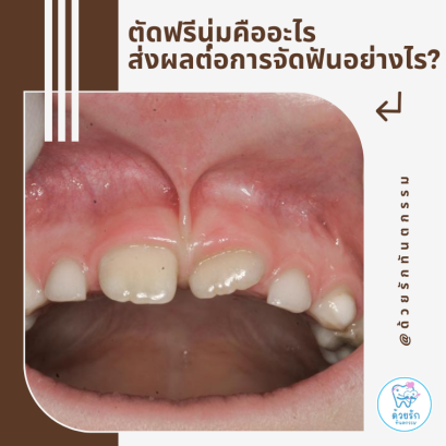 ตัดฟรีนุ่มคืออะไร ส่งผลกับการจัดฟันอย่างไร