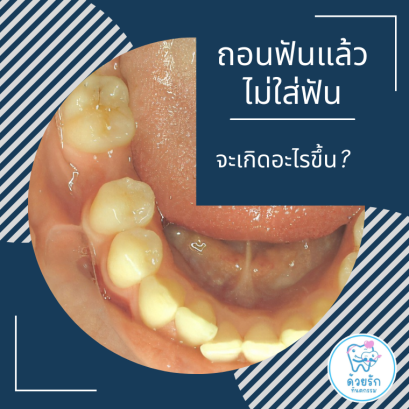 ถ้าถอนฟันแล้วไม่ใส่ฟันทดแทน จะเกิดผลเสียอย่างไร