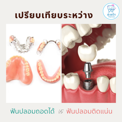 เปรียบเทียบฟันปลอมชนิดถอดได้และติดแน่น