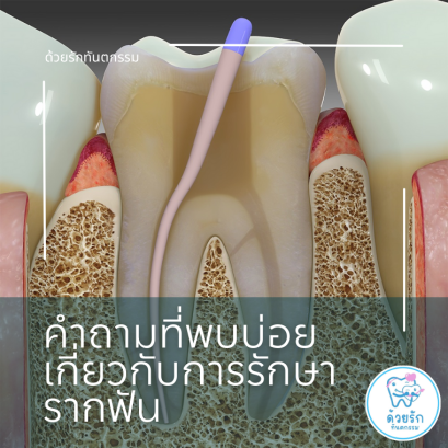 คำถามที่พบบ่อยเกี่ยวกับการรักษารากฟัน